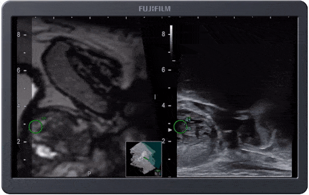 Biopsja prostaty z pomocą obrazowania MRI-US Fusion