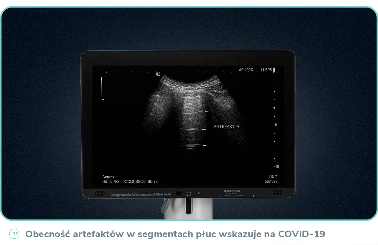 Obecność artefaktów w dolnych i tylnych segmentach płuc wskazuje na COVID-19 