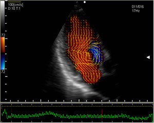 Vector Flow Mapping (VFM) to narzędzie do kwantyfikacj